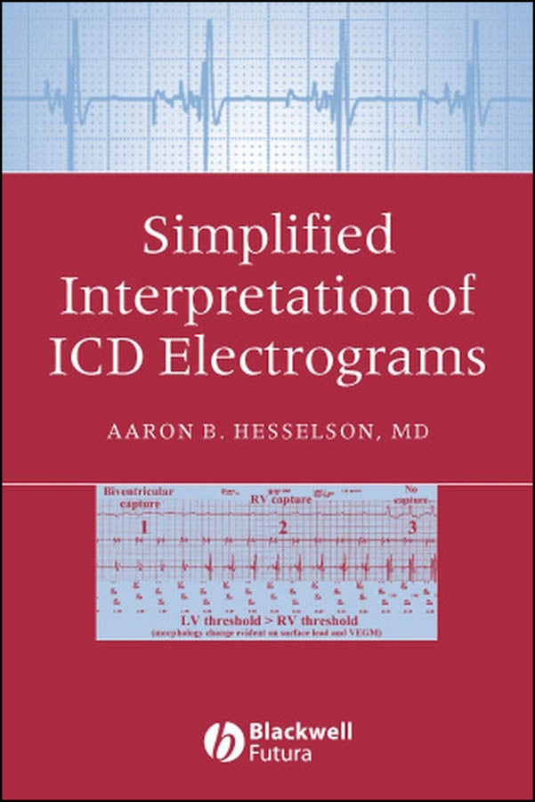 Simplified Interpretation of ICD Electrograms