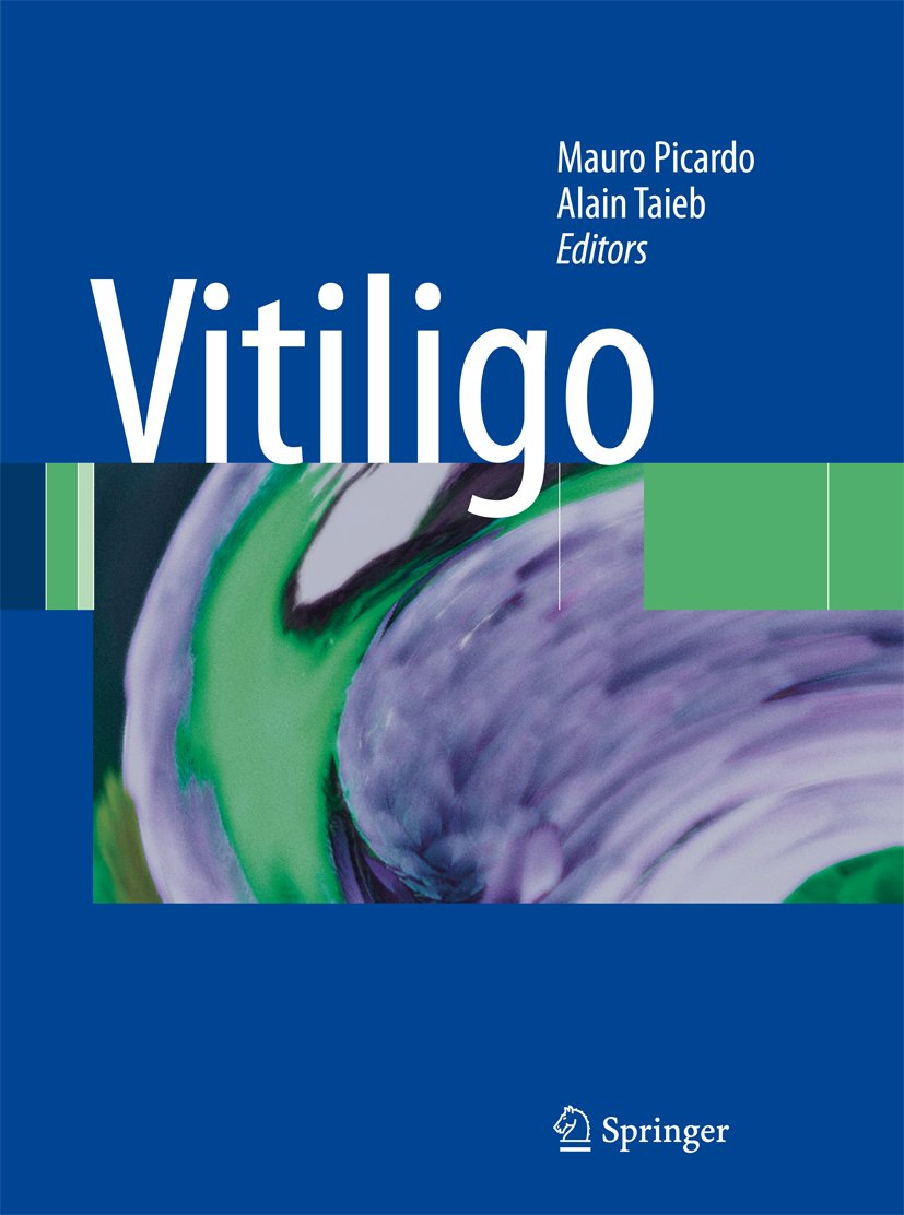 Vitiligo